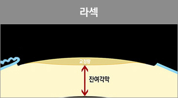 라식이미지