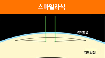 라식이미지