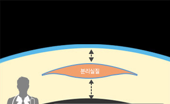 라식이미지