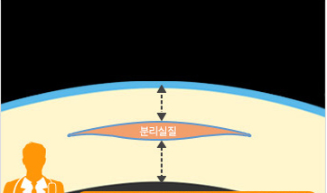 라식이미지